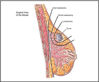 Laparoscopic surgery